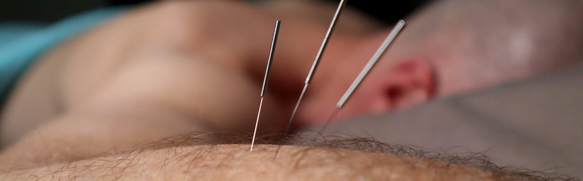 Acupuncture